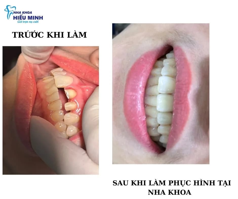 Dán sứ Veneer hay bọc răng sứ tốt hơn? So sánh thẳng thắn từng tiêu chí