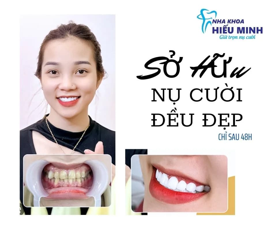 Sở hữu nụ cười đều đẹp chỉ sau 48 giờ với răng sứ thẩm mỹ