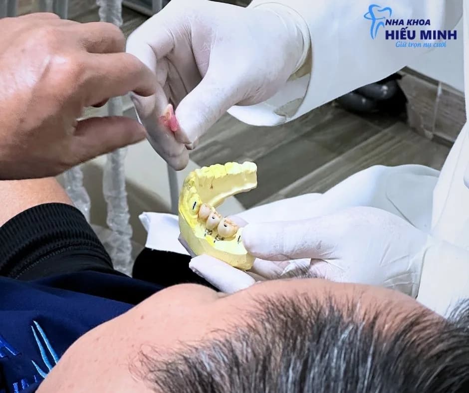 Bác sĩ giải thích cấy ghép Implant trên mô hình hàm răng