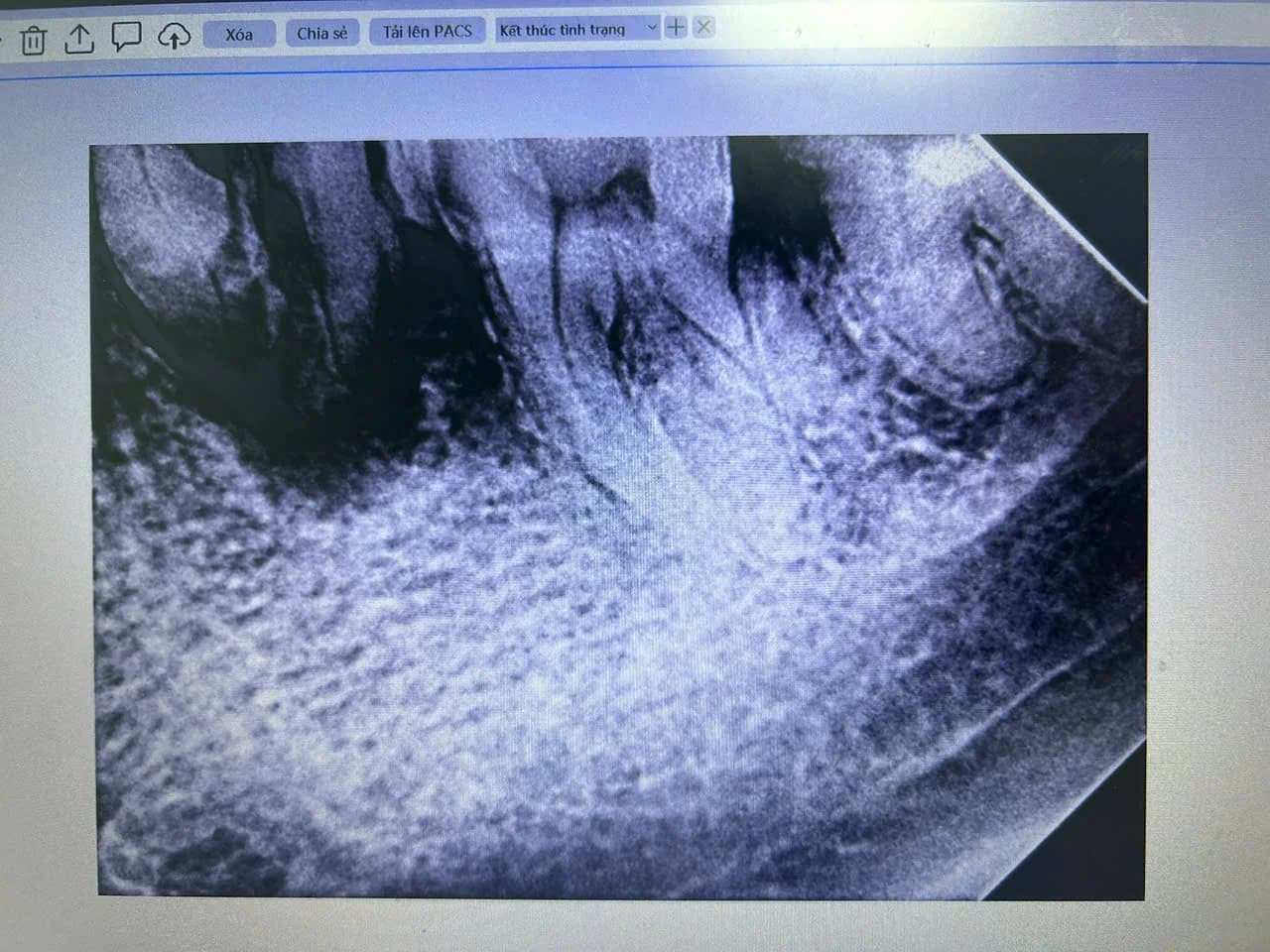 Chân răng hỏng cần nhổ bỏ trước khi cấy ghép Implant tức thì