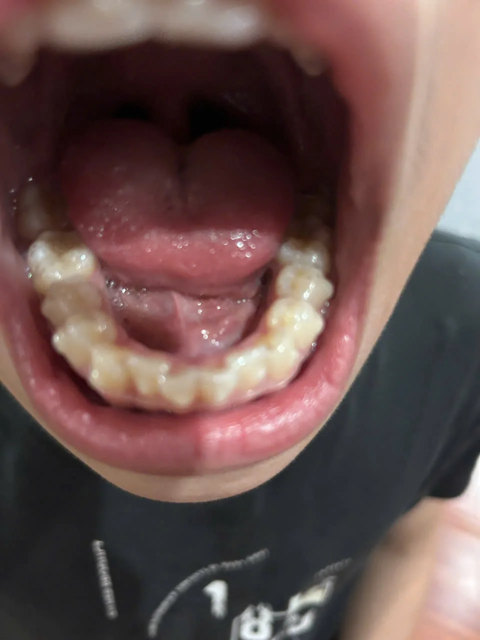 Cung răng sau chỉnh nha, các răng đã về đúng vị trí trên cung hàm