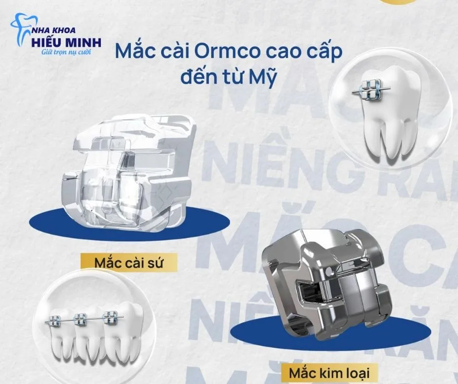 Các loại mắc cài chỉnh nha: mắc cài sứ và mắc cài kim loại Ormco Mỹ