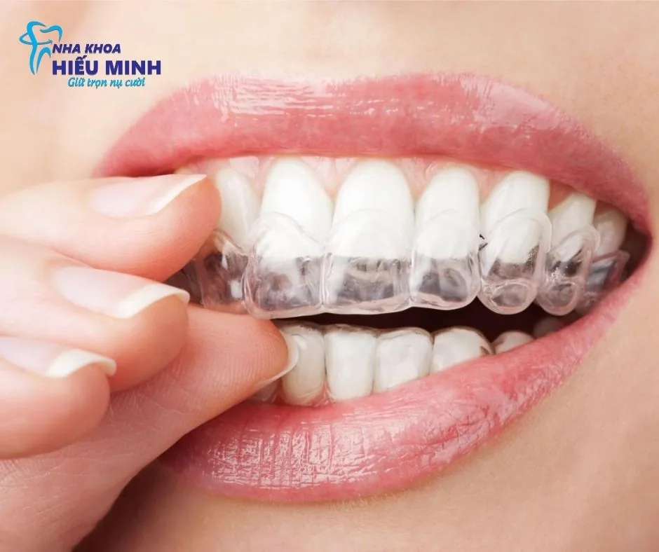 Khay niềng trong suốt Invisalign gắn trên cung răng, gần như vô hình