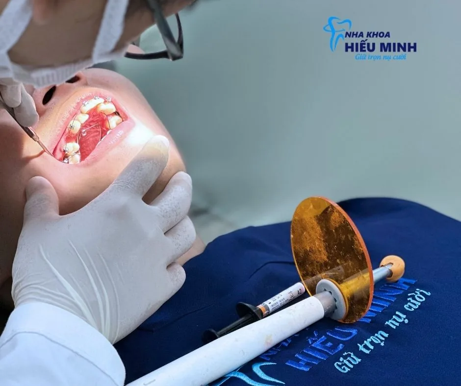 Gây tê không đau trước khi điều trị răng