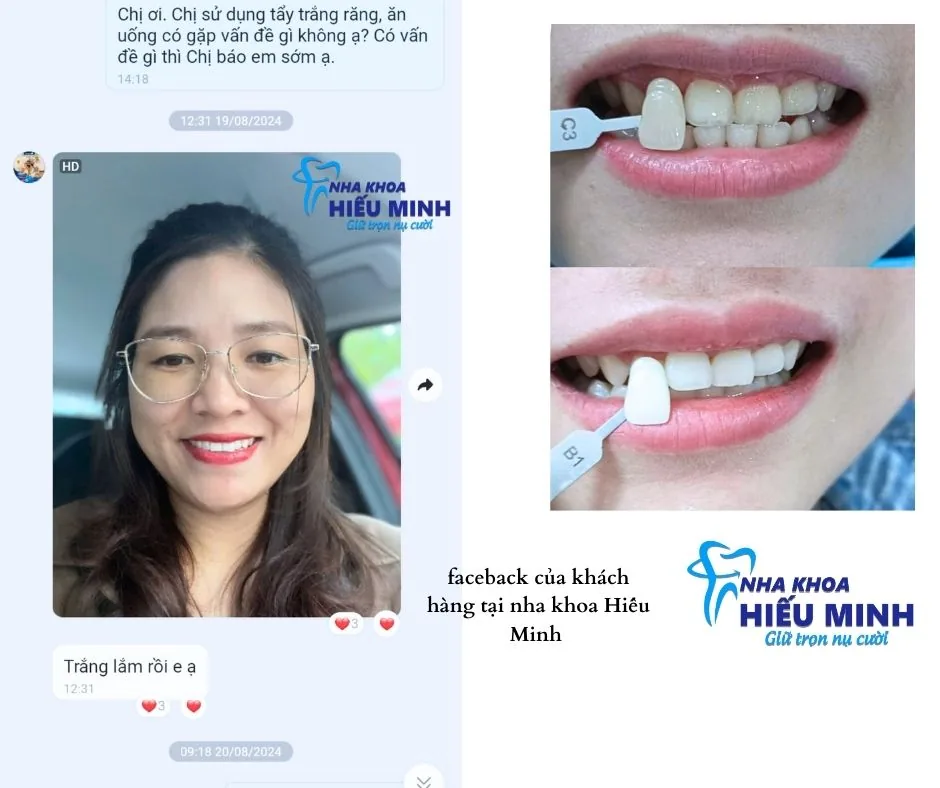Kết quả tẩy trắng răng và phản hồi thực tế của khách hàng