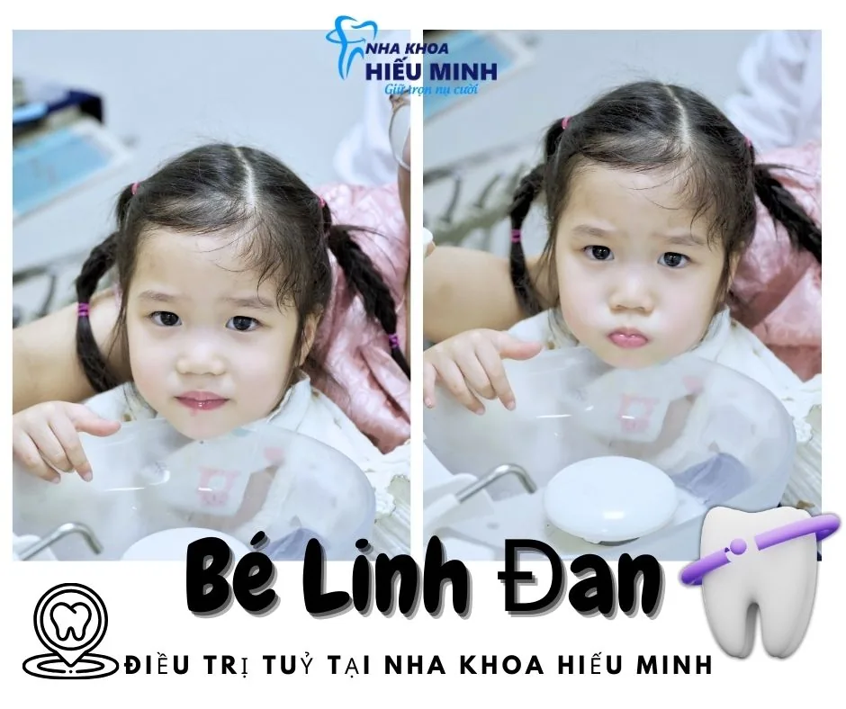 Bé Linh Đan điều trị tủy răng sữa tại Nha khoa Hiếu Minh